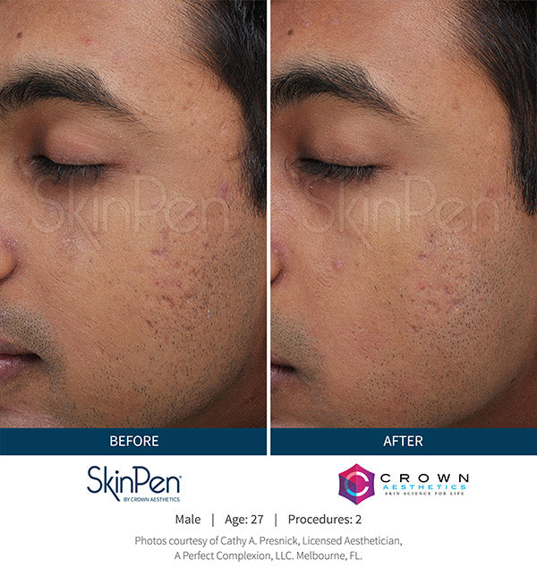 $100 OFF: MICRONEEDLING W/ PRP