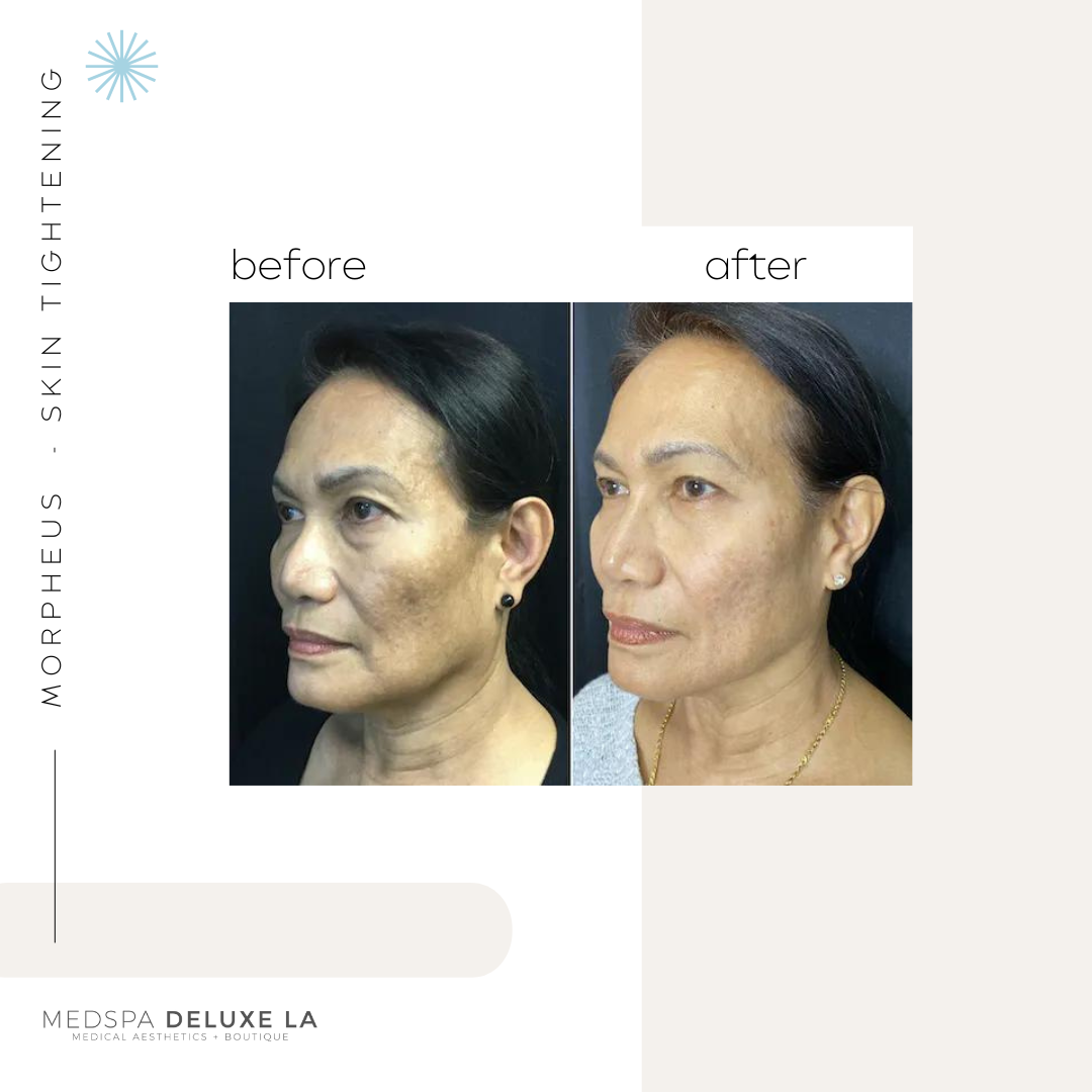 30% OFF: MORPHEUS 8 SPECIAL