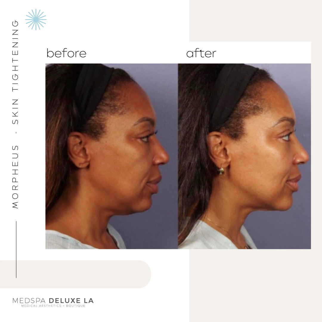 30% OFF: MORPHEUS 8 SPECIAL