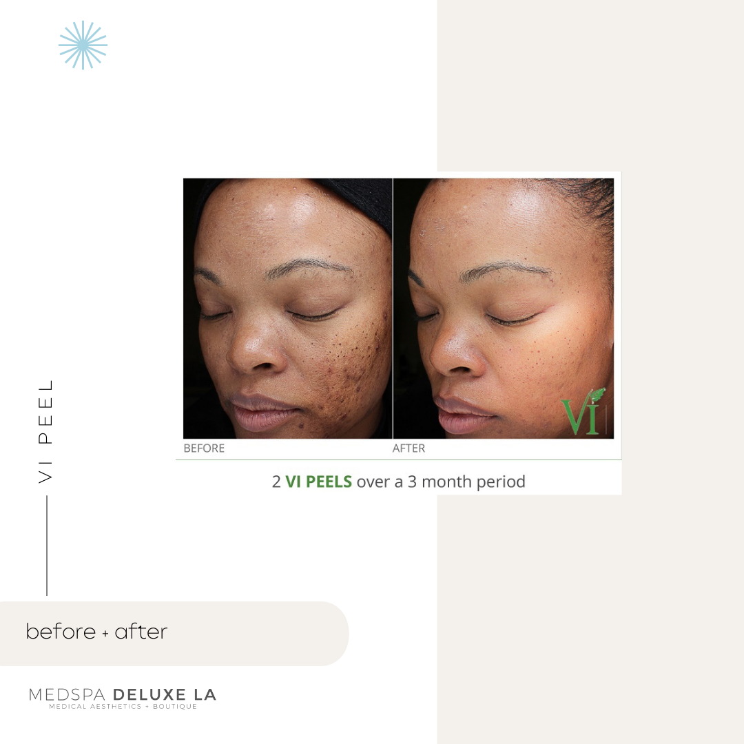 CHEMICAL PEELS -10 YEAR