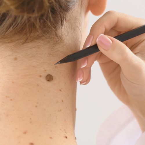 SKIN TAGS - 10 YEAR
