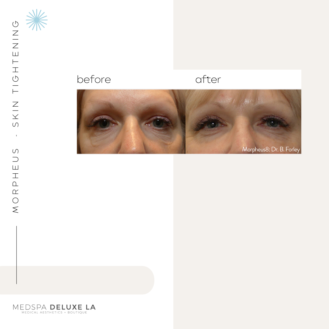 30% OFF: MORPHEUS 8 SPECIAL