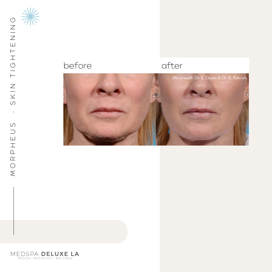 30% OFF: MORPHEUS 8 SPECIAL