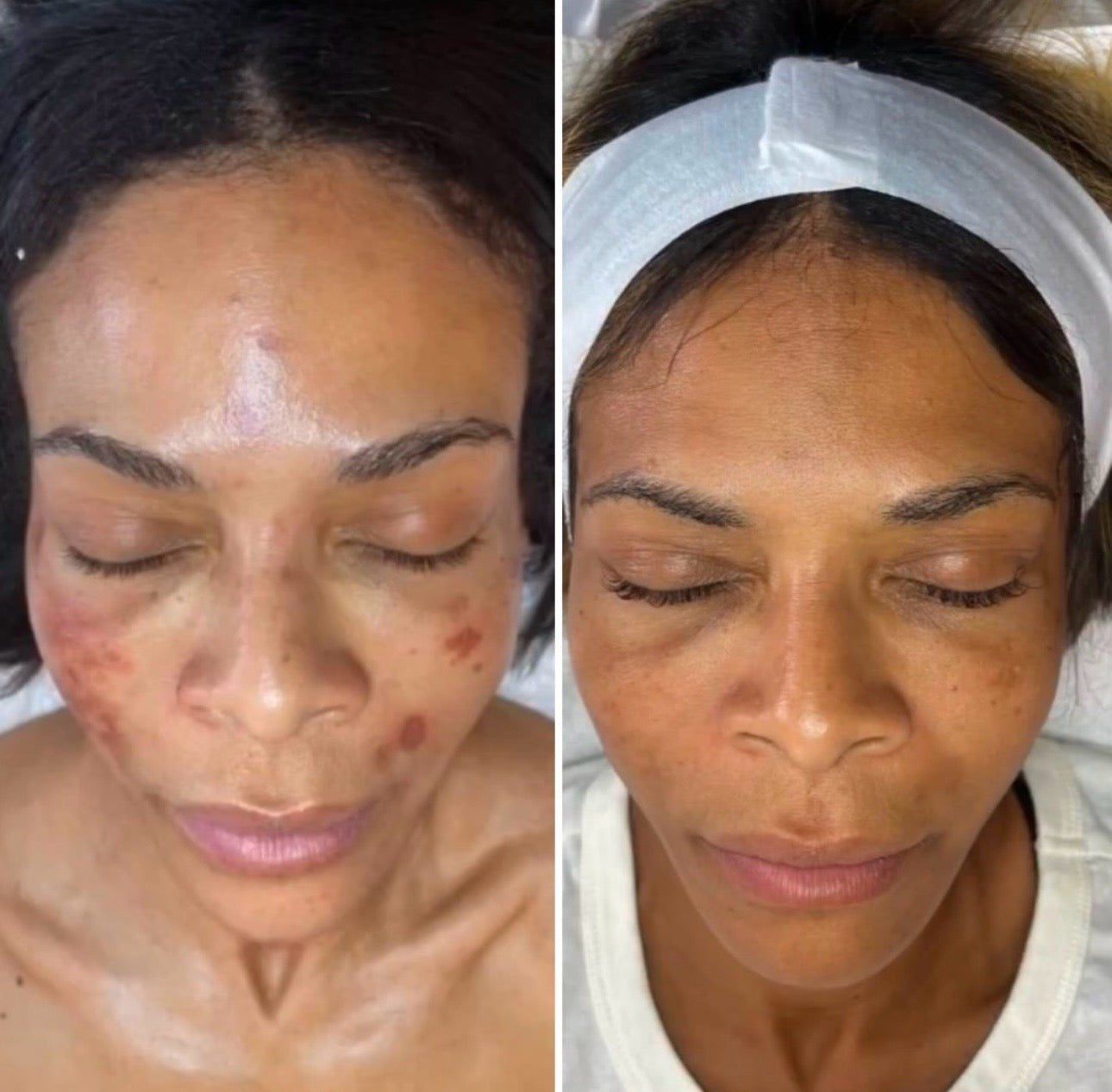 $100 OFF: MICRONEEDLING W/ PRP