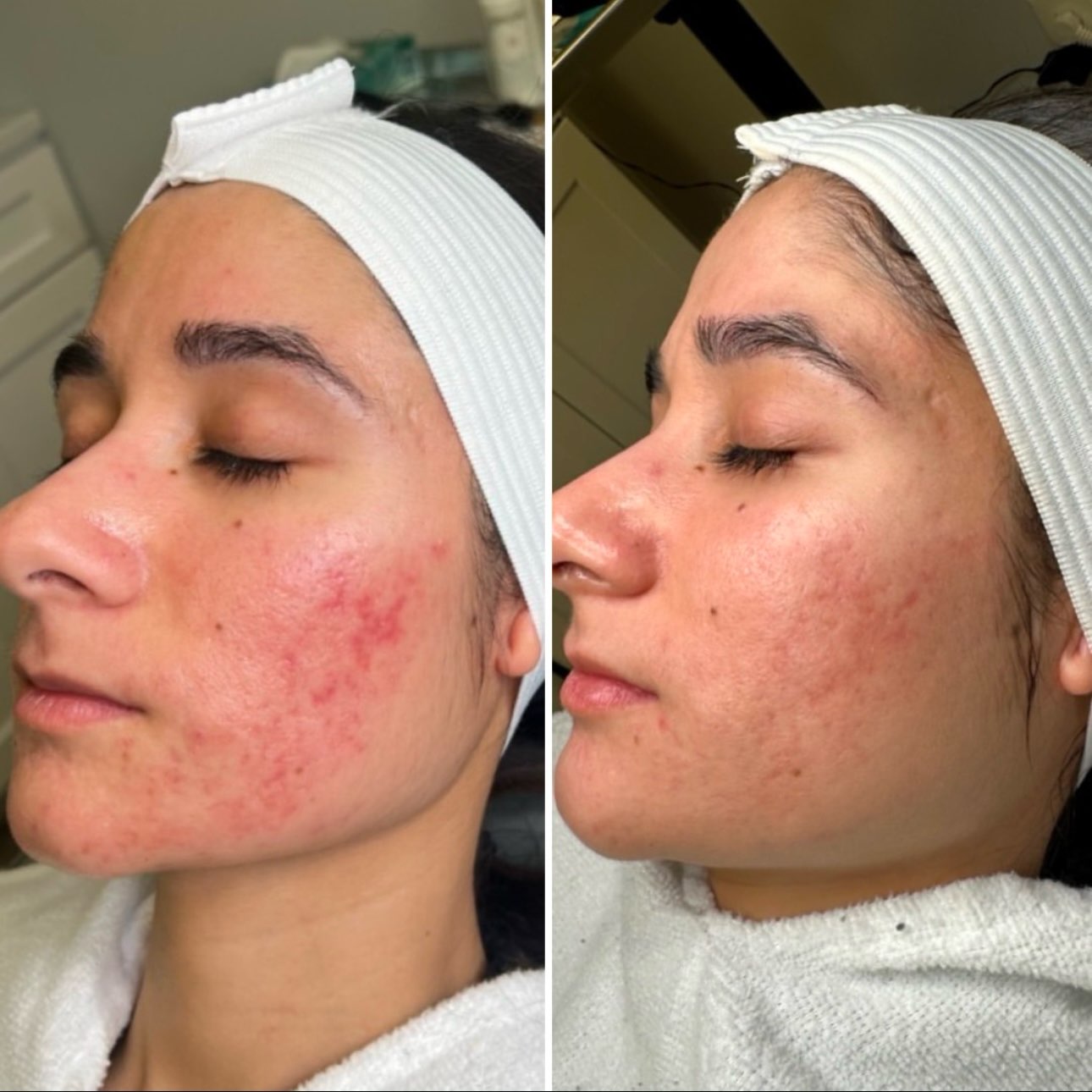 $100 OFF: MICRONEEDLING W/ PRP