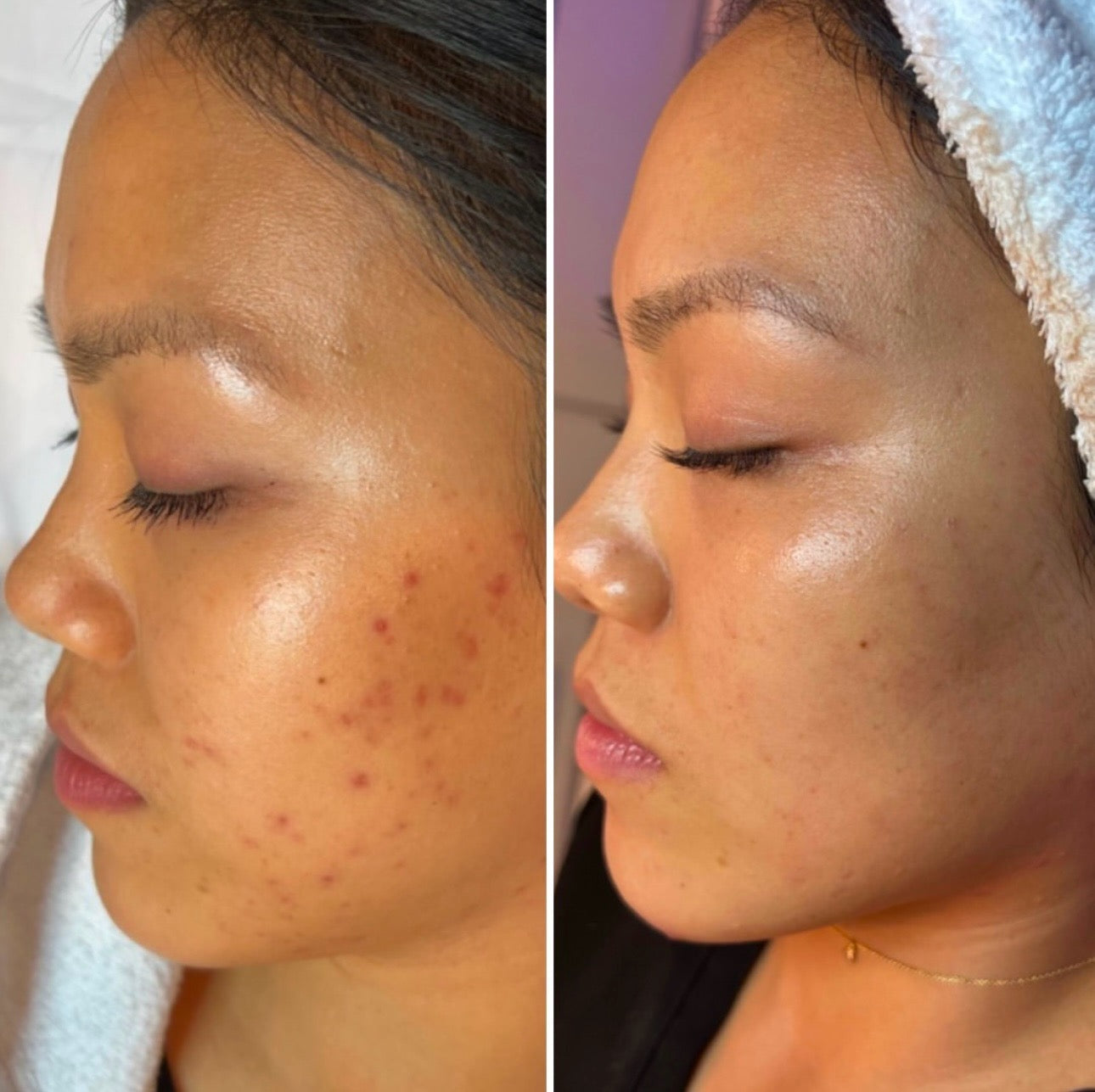 $100 OFF: MICRONEEDLING W/ PRP