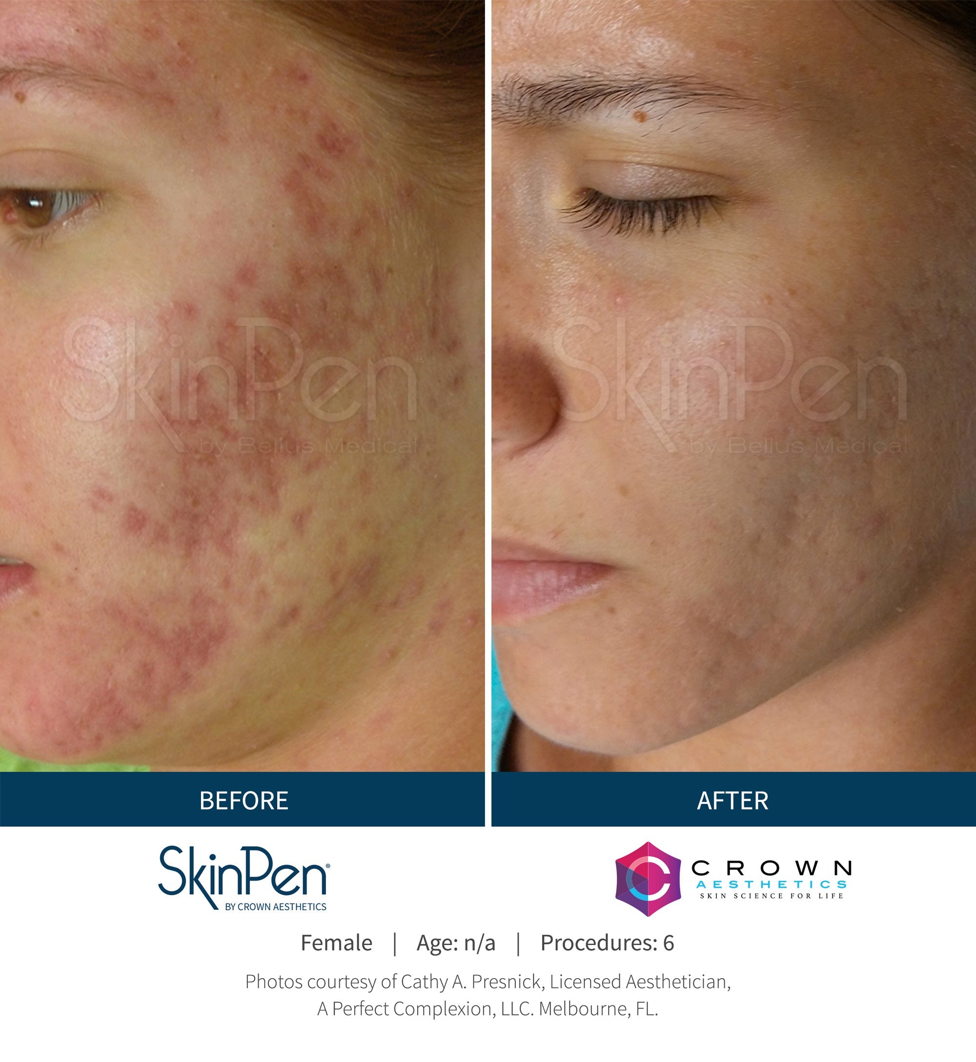 $100 OFF: MICRONEEDLING W/ PRP