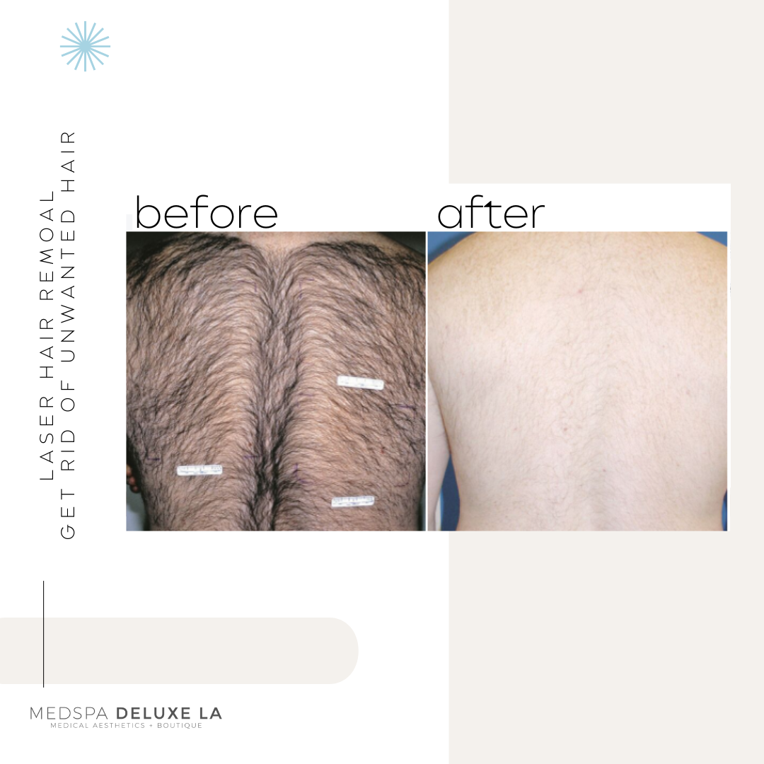 UP TO 20% OFF: LASER HAIR REMOVAL