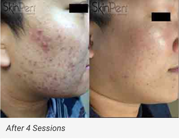 $100 OFF: MICRONEEDLING W/ PRP