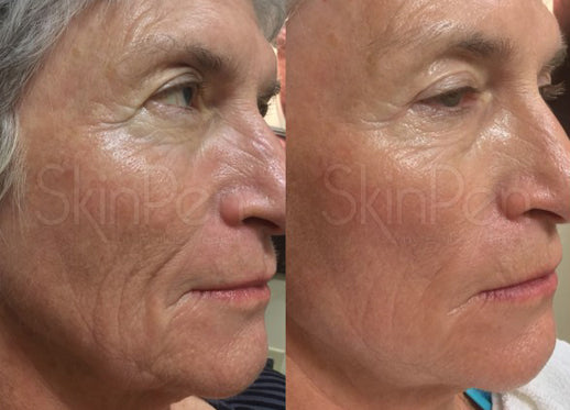 $100 OFF: MICRONEEDLING W/ PRP