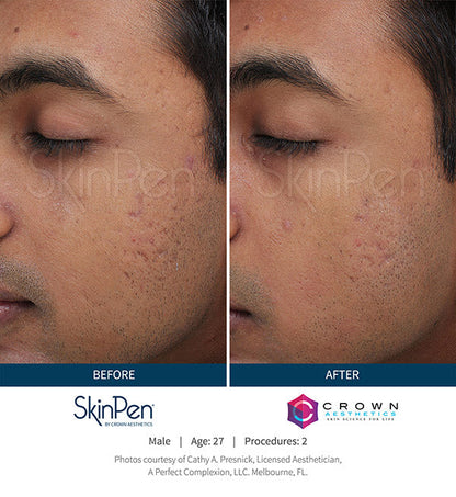 $100 OFF: MICRONEEDLING W/ PRP