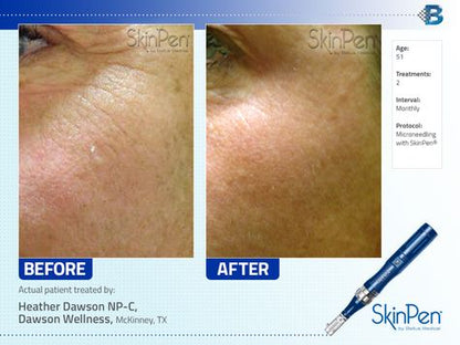 $100 OFF: MICRONEEDLING W/ PRP