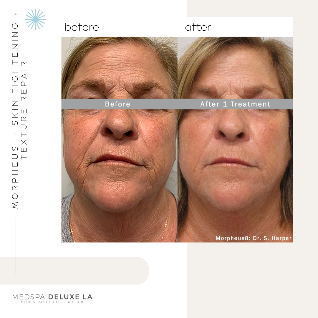 30% OFF: MORPHEUS 8 SPECIAL