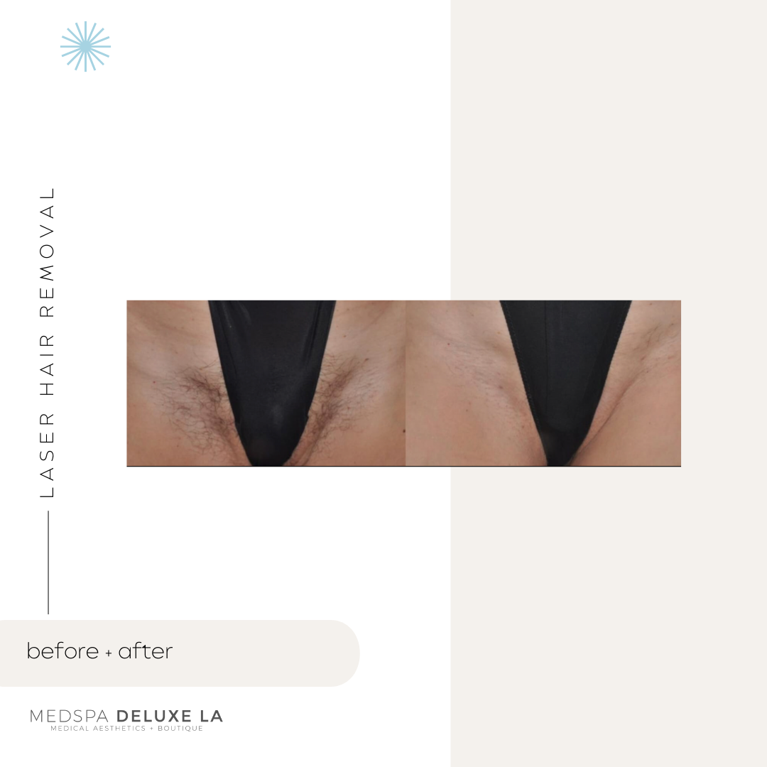 UP TO 20% OFF: LASER HAIR REMOVAL