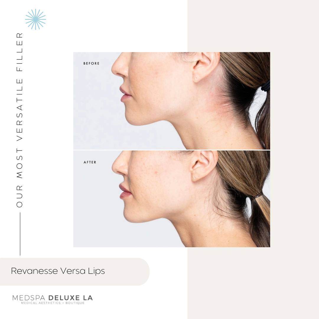 $100 OFF LIP FILLER | JUNE 2026