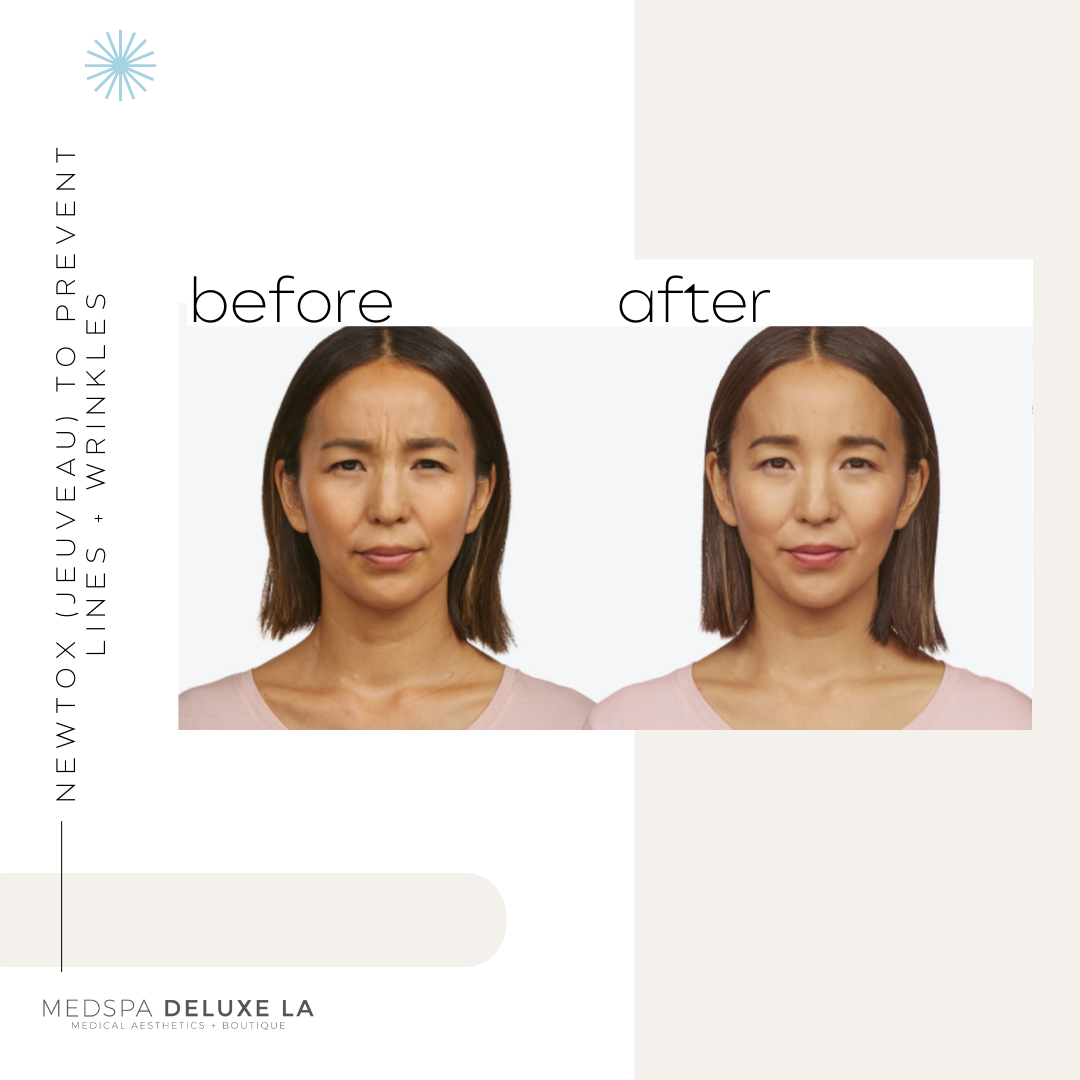 JEUVEAU BUY 55 UNITS GET $55 OFF  | MAY SPECIAL