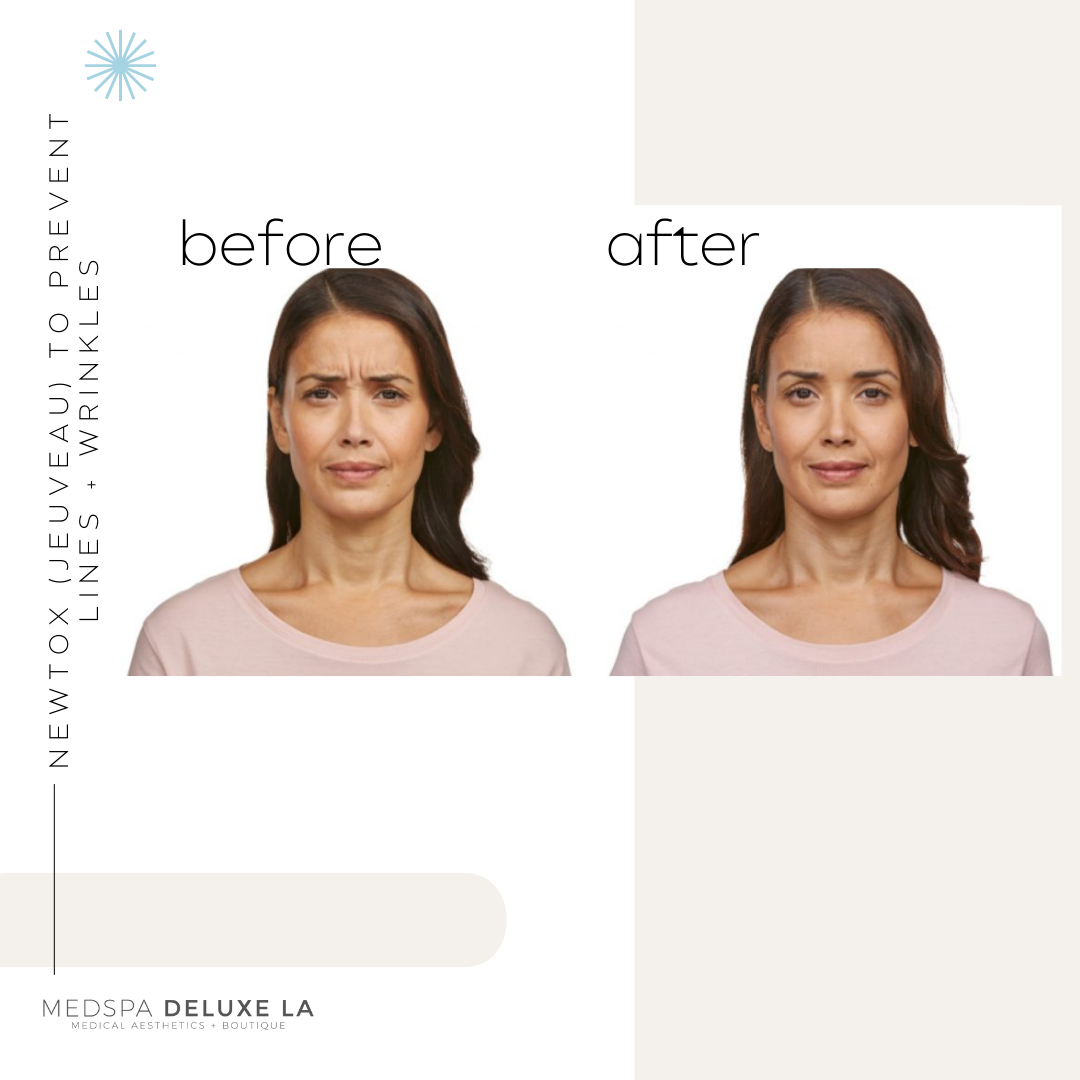 JEUVEAU BUY 55 UNITS GET $55 OFF  | MAY SPECIAL