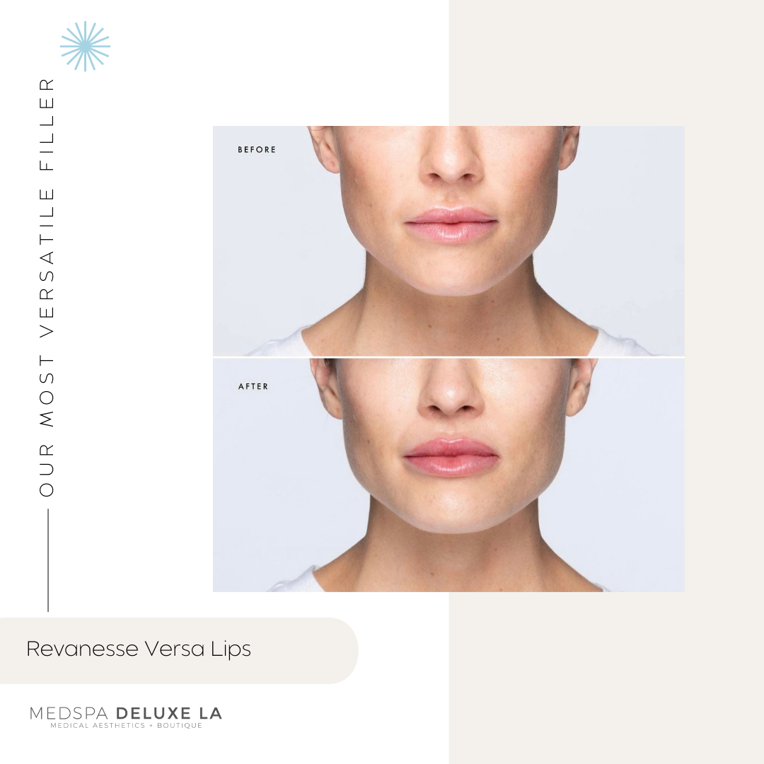 $100 OFF LIP FILLER | JUNE 2026