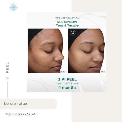 CHEMICAL PEELS -10 YEAR
