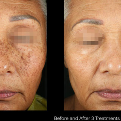 PICOSURE (PIGMENTATION) | BLACK FRIDAY 2025