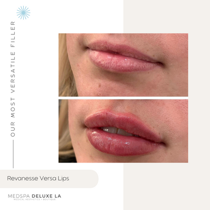 $100 OFF LIP FILLER | JUNE 2026