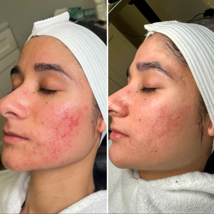 $100 OFF: MICRONEEDLING W/ PRP