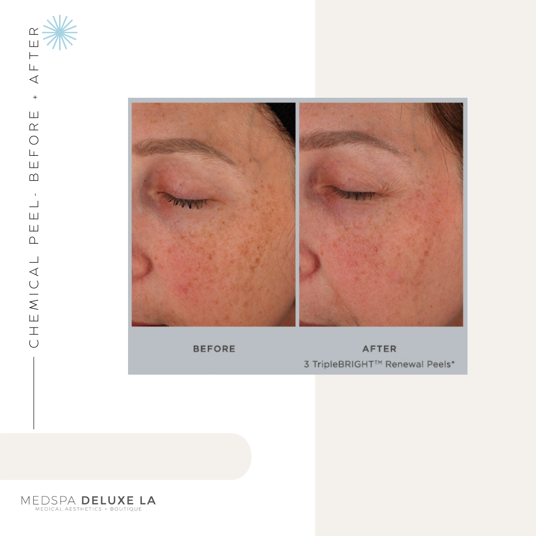 CHEMICAL PEELS -10 YEAR