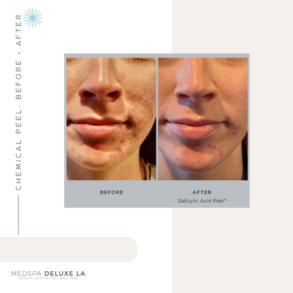 CHEMICAL PEELS -10 YEAR