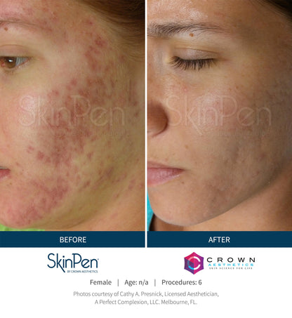 $100 OFF: MICRONEEDLING W/ PRP