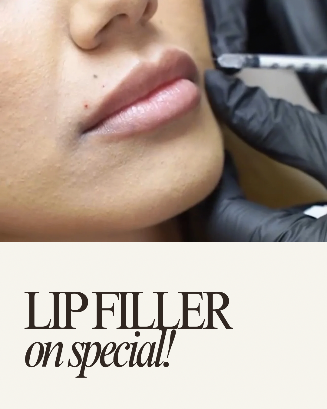 1/2 syringe of Lip Filler