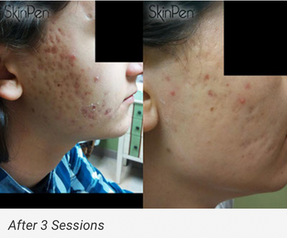 $100 OFF: MICRONEEDLING W/ PRP