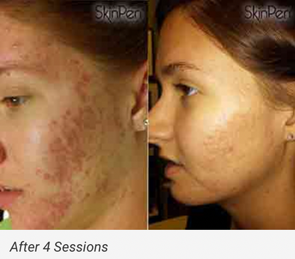 $100 OFF: MICRONEEDLING W/ PRP