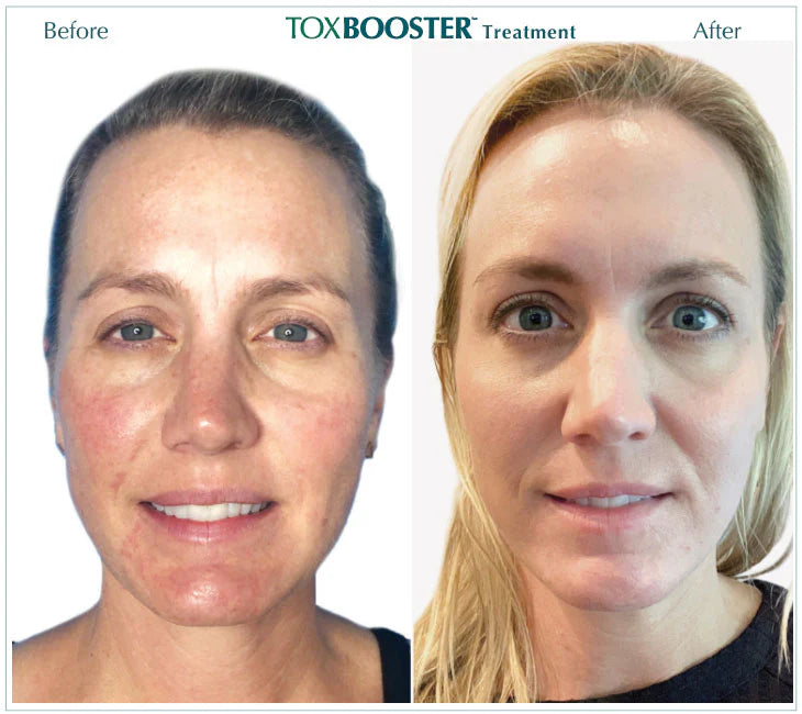 TOXBOOSTER WITH VI PEEL $200 OFF | JUNE 2026