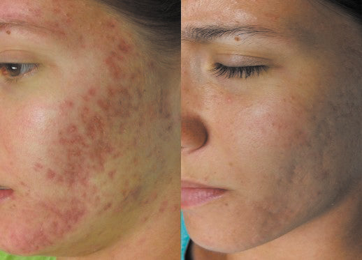 $100 OFF: MICRONEEDLING W/ PRP