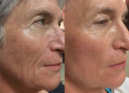 $100 OFF: MICRONEEDLING W/ PRP