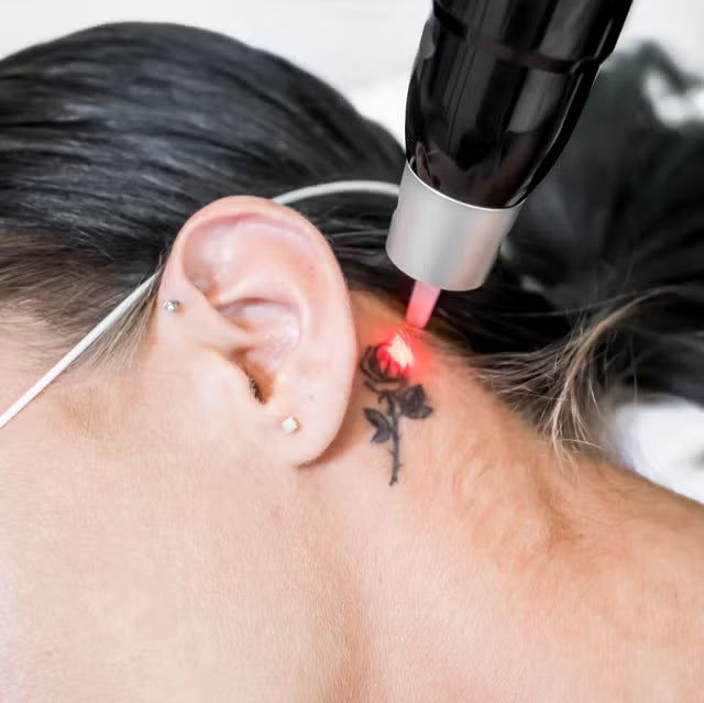 TATTOO REMOVAL | BLACK FRIDAY 2025